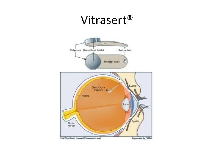 Vitrasert® 