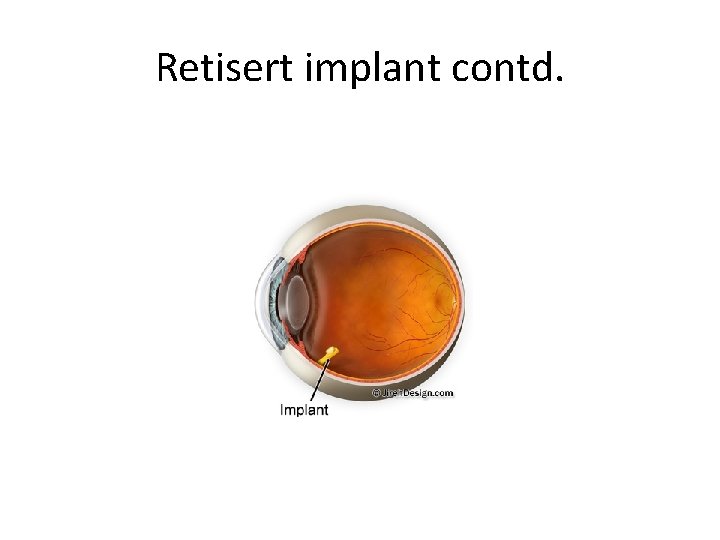 Retisert implant contd. 