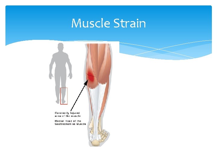 Muscle Strain 