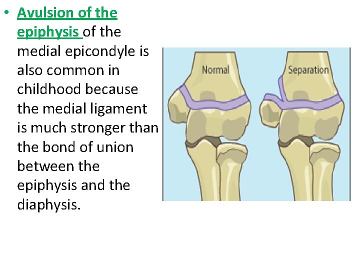  • Avulsion of the epiphysis of the medial epicondyle is also common in