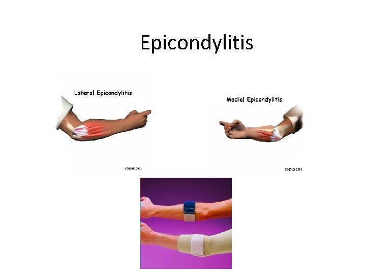 Epicondylitis 