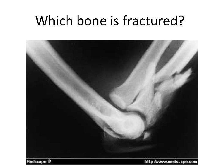 Which bone is fractured? 