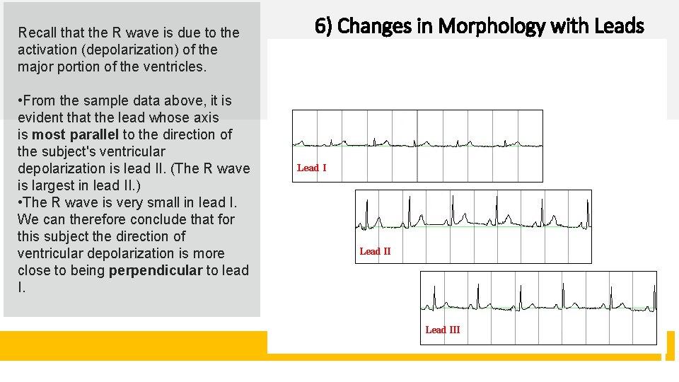 Recall that the R wave is due to the activation (depolarization) of the major