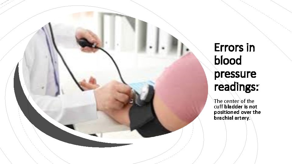 Errors in blood pressure readings: The center of the cuff bladder is not positioned