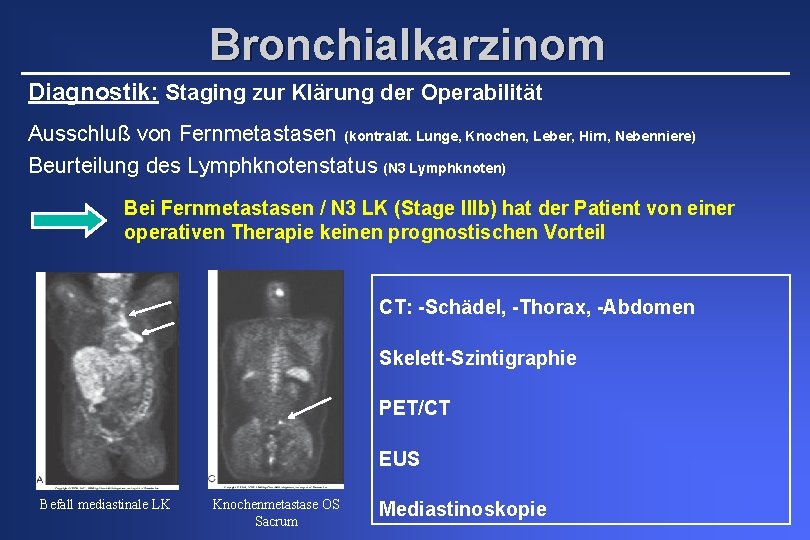 Bronchialkarzinom Diagnostik: Staging zur Klärung der Operabilität Ausschluß von Fernmetastasen (kontralat. Lunge, Knochen, Leber,