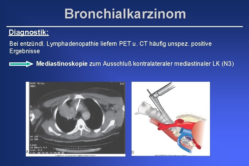 Bronchialkarzinom Diagnostik: Bei entzündl. Lymphadenopathie liefern PET u. CT häufig unspez. positive Ergebnisse Mediastinoskopie