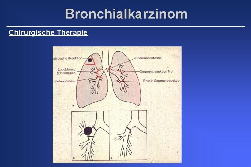 Bronchialkarzinom Chirurgische Therapie 