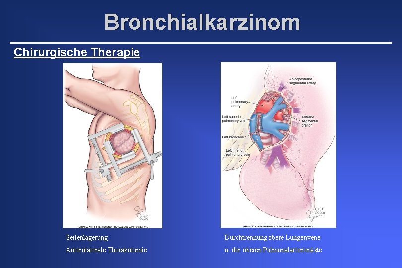 Bronchialkarzinom Chirurgische Therapie Seitenlagerung Durchtrennung obere Lungenvene Anterolaterale Thorakotomie u. der oberen Pulmonalarterienäste 