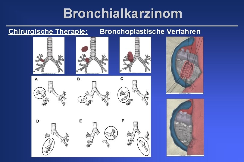 Bronchialkarzinom Chirurgische Therapie: Bronchoplastische Verfahren 