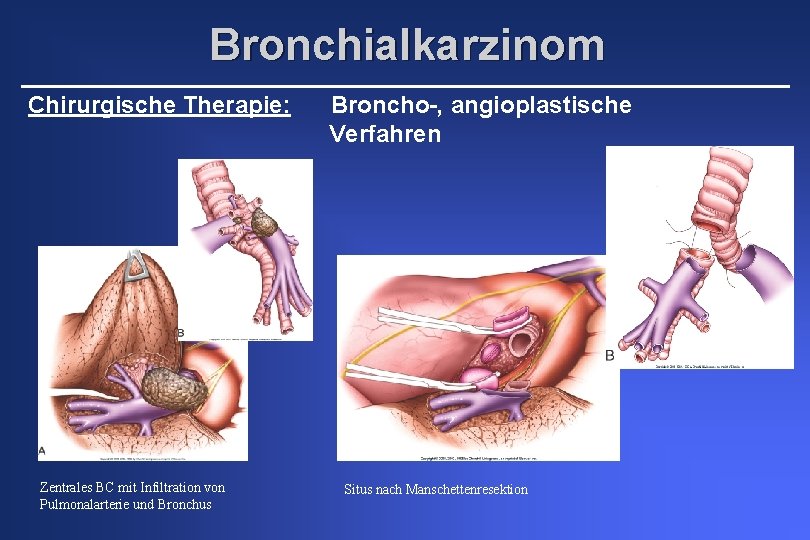 Bronchialkarzinom Chirurgische Therapie: Zentrales BC mit Infiltration von Pulmonalarterie und Bronchus Broncho-, angioplastische Verfahren