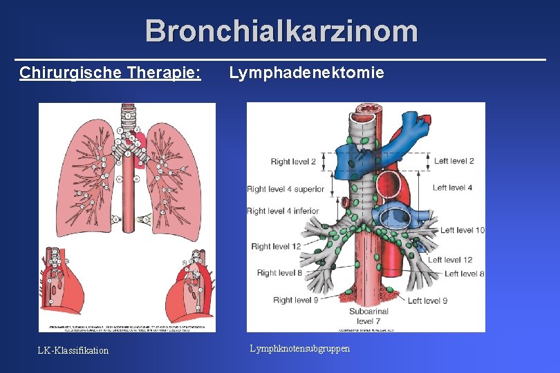Bronchialkarzinom Chirurgische Therapie: LK-Klassifikation Lymphadenektomie Lymphknotensubgruppen 