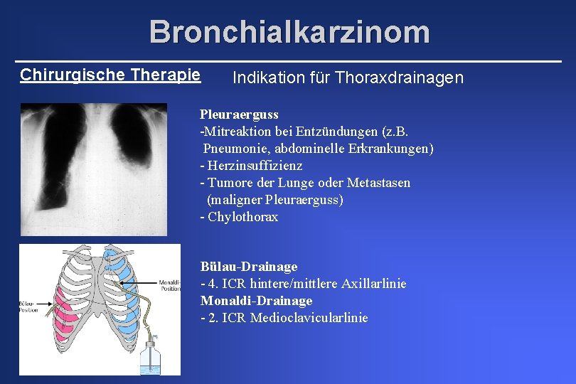Bronchialkarzinom Chirurgische Therapie Indikation für Thoraxdrainagen Pleuraerguss -Mitreaktion bei Entzündungen (z. B. Pneumonie, abdominelle