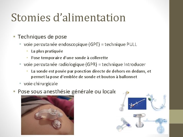 Stomies d’alimentation • Techniques de pose • voie percutanée endoscopique (GPE) = technique PULL