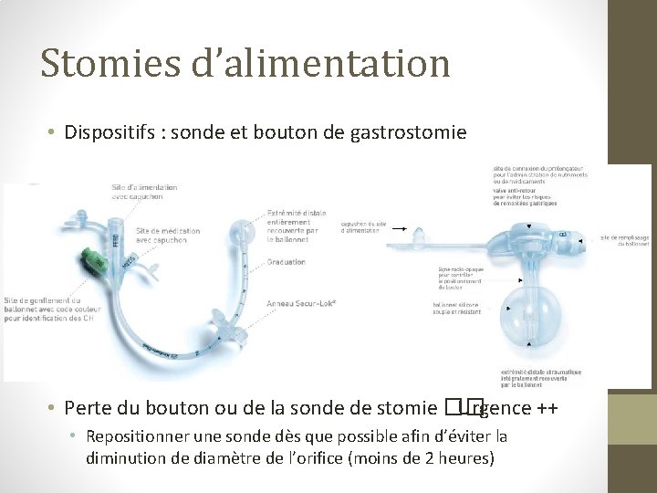 Stomies d’alimentation • Dispositifs : sonde et bouton de gastrostomie • Perte du bouton