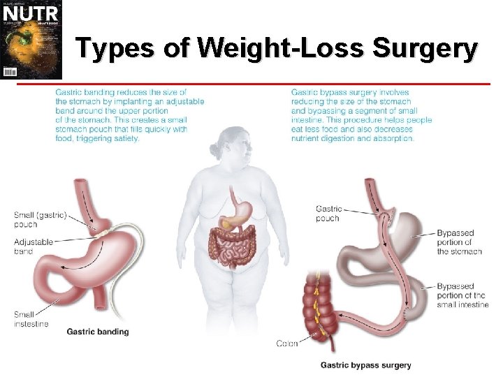 Types of Weight-Loss Surgery 