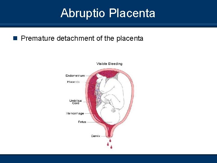 Abruptio Placenta n Premature detachment of the placenta 