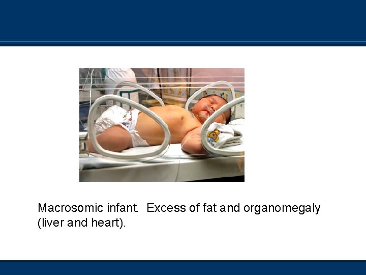 Macrosomic infant. Excess of fat and organomegaly (liver and heart). 