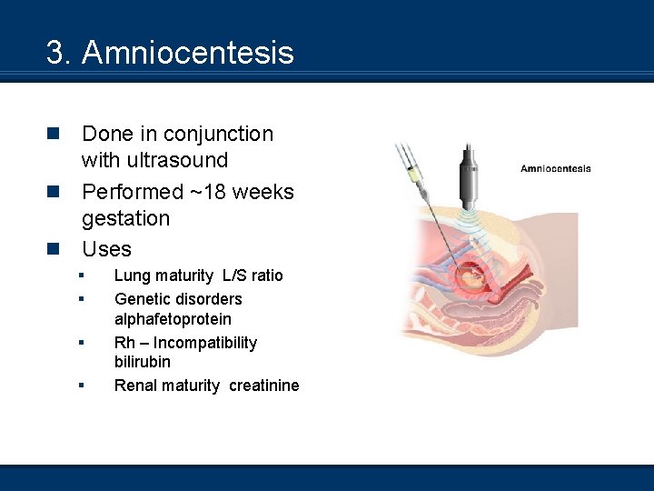 3. Amniocentesis n n n Done in conjunction with ultrasound Performed ~18 weeks gestation