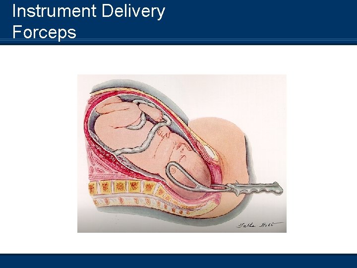 Instrument Delivery Forceps 