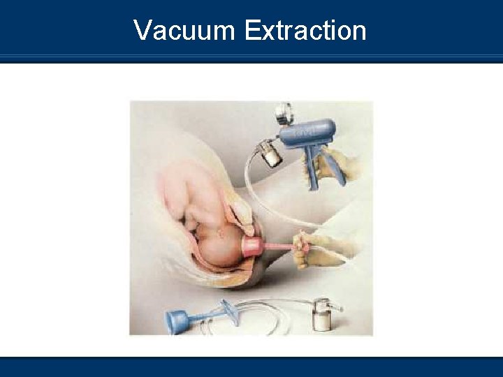 Vacuum Extraction 