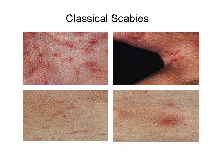 Classical Scabies 