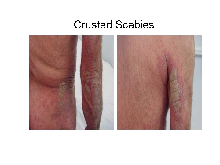 Crusted Scabies 