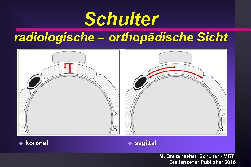 Schulter radiologische – orthopädische Sicht u koronal u sagittal M. Breitenseher, Schulter - MRT,