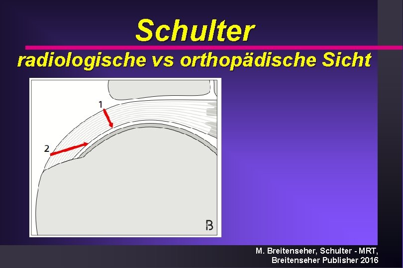 Schulter radiologische vs orthopädische Sicht M. Breitenseher, Schulter - MRT, Breitenseher Publisher 2016 