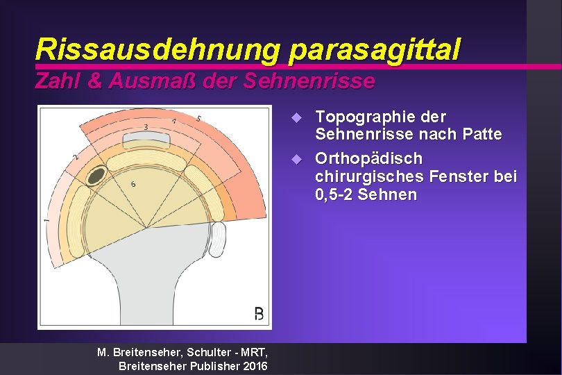 Rissausdehnung parasagittal Zahl & Ausmaß der Sehnenrisse u u M. Breitenseher, Schulter - MRT,