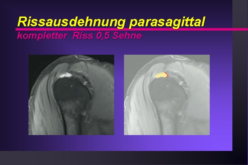 Rissausdehnung parasagittal kompletter Riss 0, 5 Sehne 