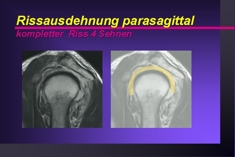 Rissausdehnung parasagittal kompletter Riss 4 Sehnen 