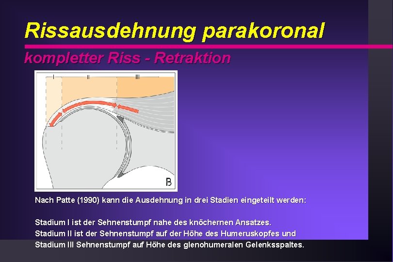 Rissausdehnung parakoronal kompletter Riss - Retraktion Nach Patte (1990) kann die Ausdehnung in drei