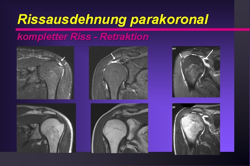 Rissausdehnung parakoronal kompletter Riss - Retraktion 