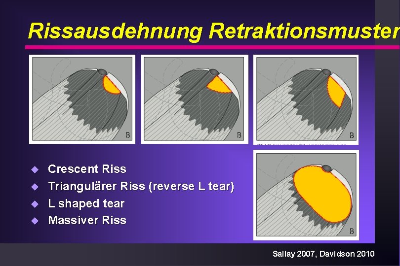 Rissausdehnung Retraktionsmuster u u Crescent Riss Triangulärer Riss (reverse L tear) L shaped tear