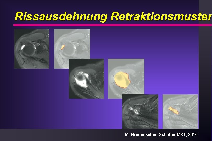 Rissausdehnung Retraktionsmuster M. Breitenseher, Schulter MRT, 2016 