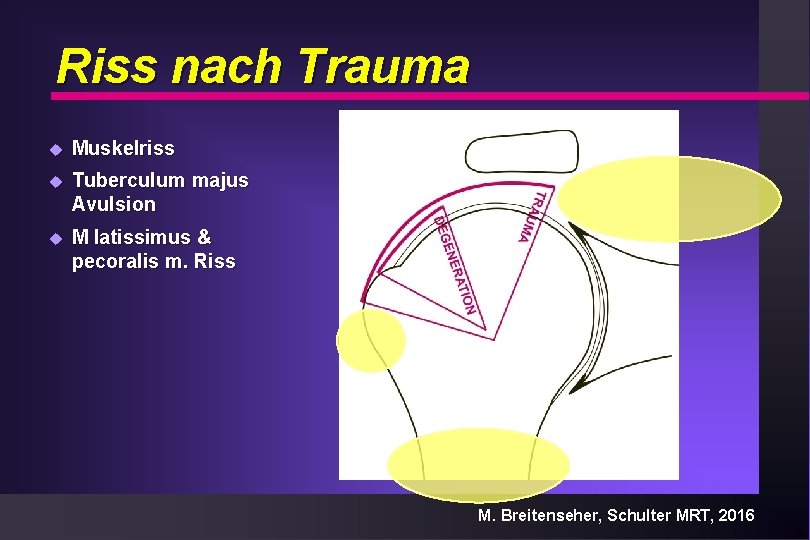 Riss nach Trauma u Muskelriss u Tuberculum majus Avulsion u M latissimus & pecoralis