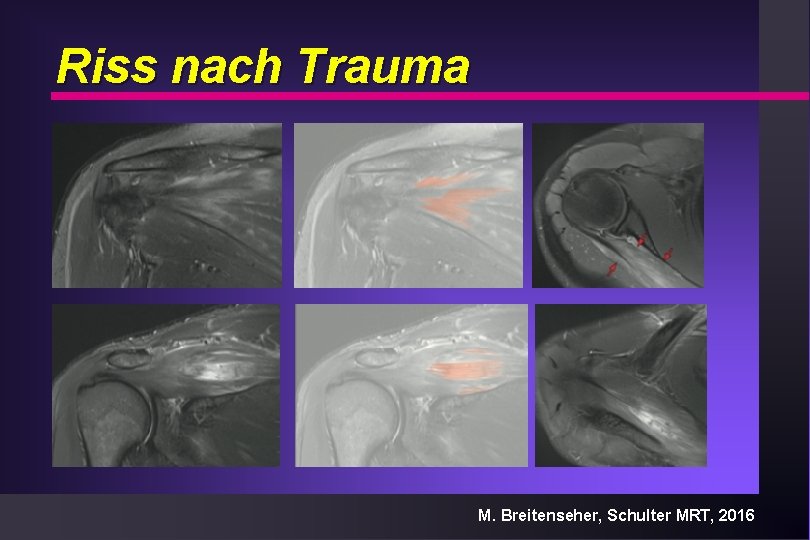 Riss nach Trauma M. Breitenseher, Schulter MRT, 2016 