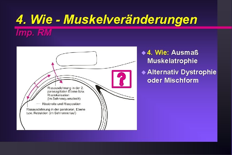 4. Wie - Muskelveränderungen Imp. RM u 4. Wie: Ausmaß Muskelatrophie u Alternativ Dystrophie