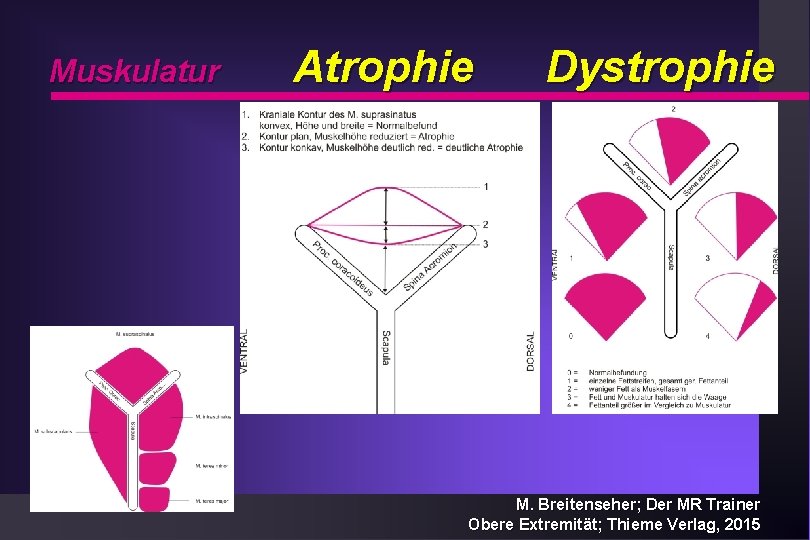 Muskulatur Atrophie Dystrophie M. Breitenseher; Der MR Trainer Obere Extremität; Thieme Verlag, 2015 