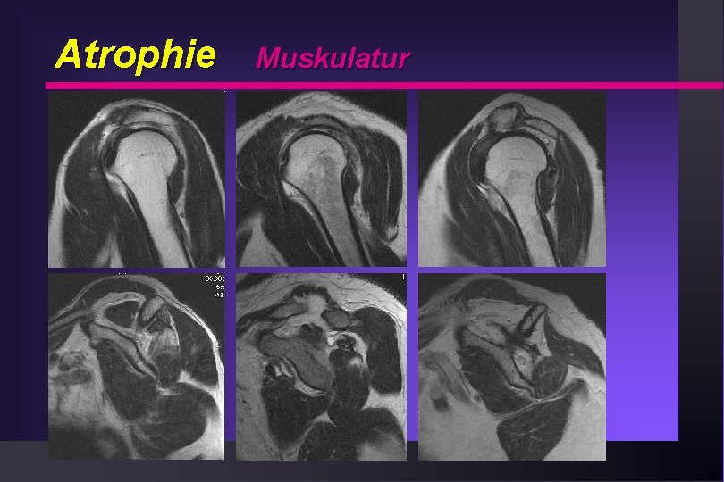 Atrophie 5. 47 Muskulatur 