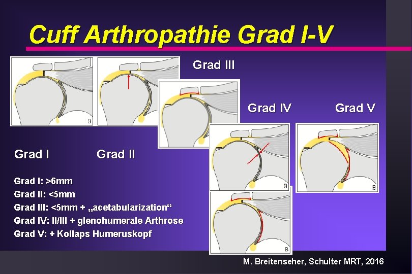 Cuff Arthropathie Grad I-V Grad III Grad IV Grad I Grad V Grad II