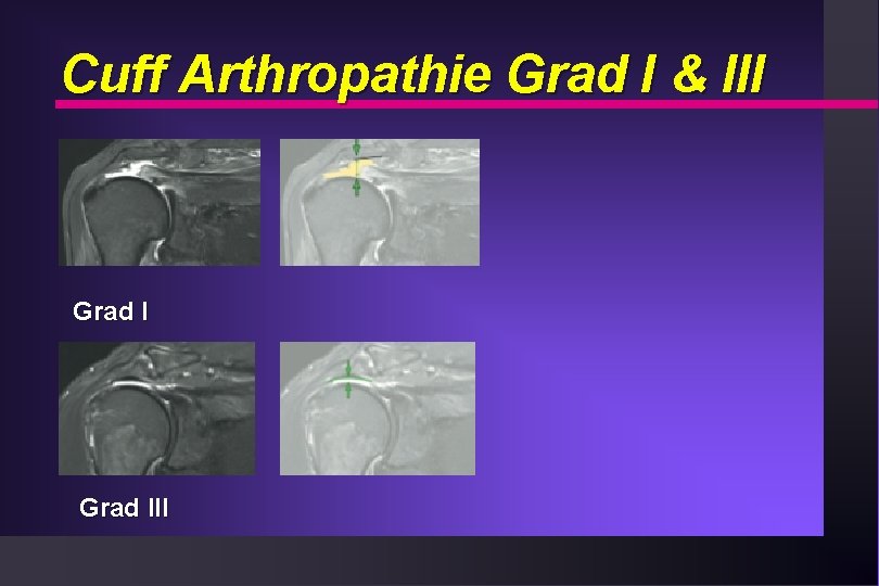 Cuff Arthropathie Grad I & III Grad III 