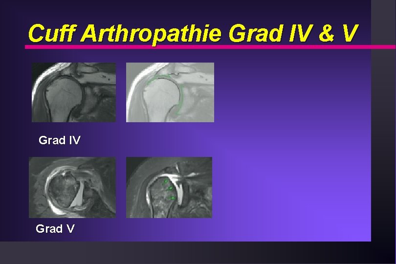 Cuff Arthropathie Grad IV & V Grad IV Grad V 