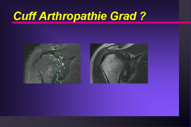 Cuff Arthropathie Grad ? 