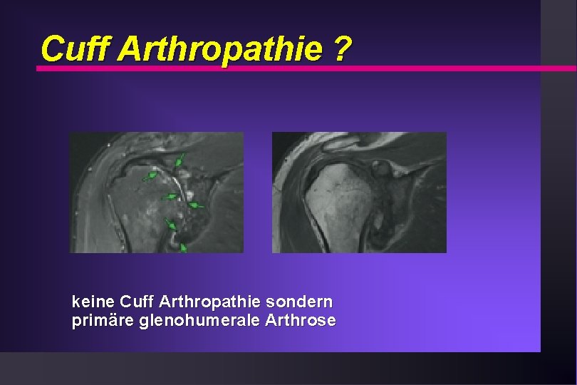 Cuff Arthropathie ? keine Cuff Arthropathie sondern primäre glenohumerale Arthrose 