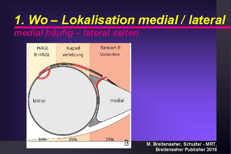 1. Wo – Lokalisation medial / lateral medial häufig – lateral selten M. Breitenseher,