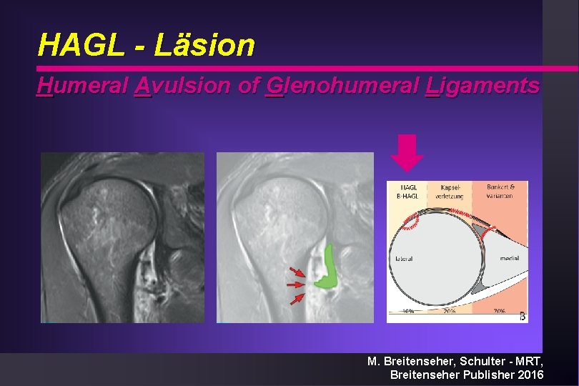 HAGL - Läsion Humeral Avulsion of Glenohumeral Ligaments M. Breitenseher, Schulter - MRT, Breitenseher