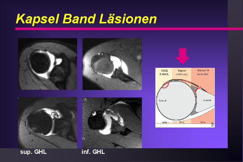 Kapsel Band Läsionen sup. GHL inf. GHL 