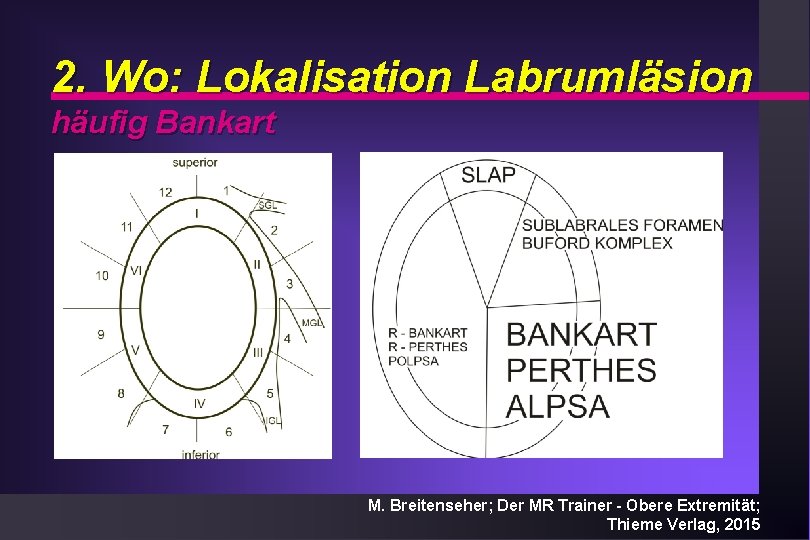 2. Wo: Lokalisation Labrumläsion häufig Bankart Keyl 1982 M. Breitenseher; Der MR Trainer -