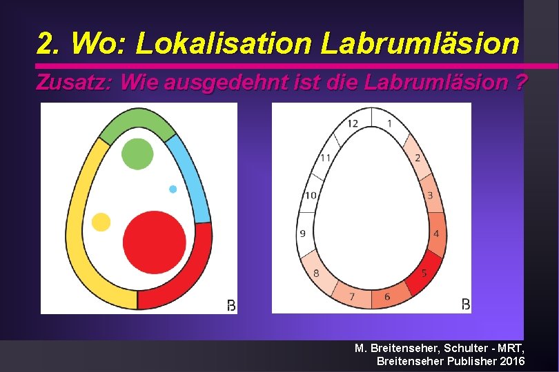 2. Wo: Lokalisation Labrumläsion Zusatz: Wie ausgedehnt ist die Labrumläsion ? M. Breitenseher, Schulter